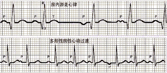 心电图学习三